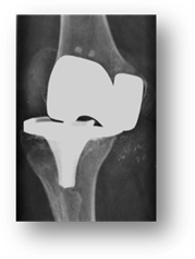 Usure et faillite ligamentaire d’une prothèse totale du genou