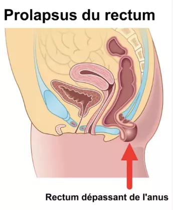 prolapsus rectum
