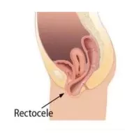 rectocele