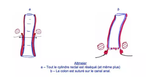 Prolapsus Rectal Hopital Dcss