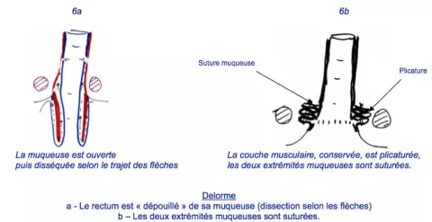 Prolapsus Rectal Hopital Dcss