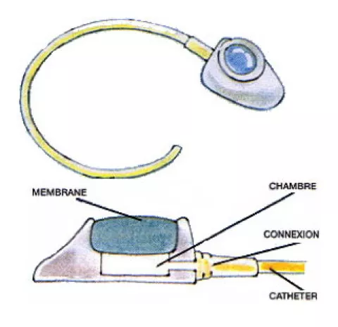 Baloo : le coussin de ceinture pour chambre implantable/PAC