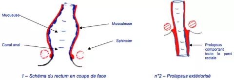 Prolapsus Rectal Hopital Dcss