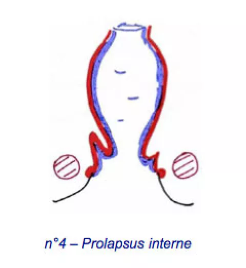 Prolapsus rectal | Hôpital DCSS