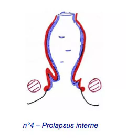 Prolapsus Rectal Hopital Dcss