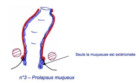 Prolapsus Rectal Hopital Dcss