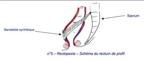 Prolapsus rectal | Hôpital DCSS