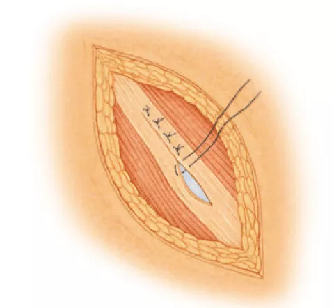 Hernie ombilicale hernie de la ligne blanche hernie epigastrique Hopital DCSS